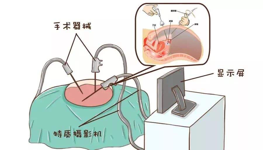 什么人適合腹腔鏡檢查呢？