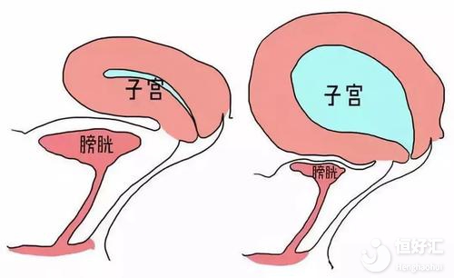 在胚胎移植前要憋尿？為什么？