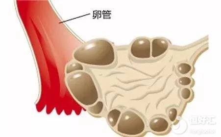 多囊卵巢綜合征最惦記肥胖人群，是真的嗎？