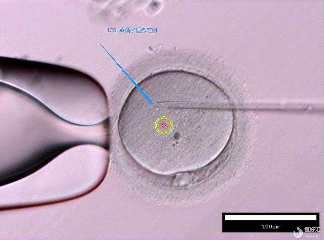 單精子卵泡漿細(xì)胞顯微注射技術(shù)是如何進(jìn)行的呢？