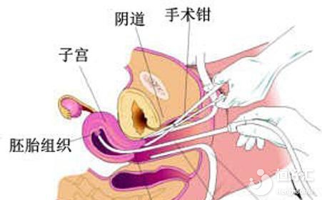 第一胎打胎的后果，看完你還敢亂來嗎？