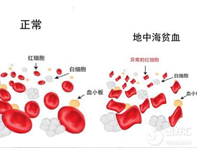 地中海貧血會遺傳嗎？第三代試管技術(shù)怎么避免？