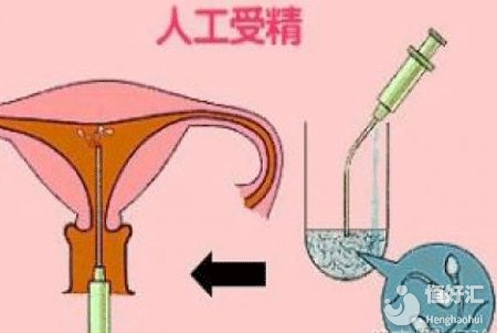 上海人工授精費(fèi)用講解，這4大因素影響最終價(jià)格！