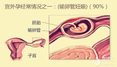 做試管嬰兒為什么也會宮外孕？其原因很常見