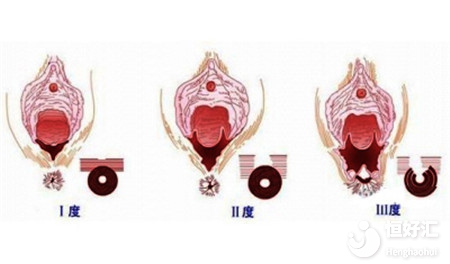 以下產婦可能需要會陰切除術，來看看有沒有你？