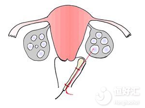 試管嬰兒取卵對(duì)身體有影響？或許是你想錯(cuò)了！